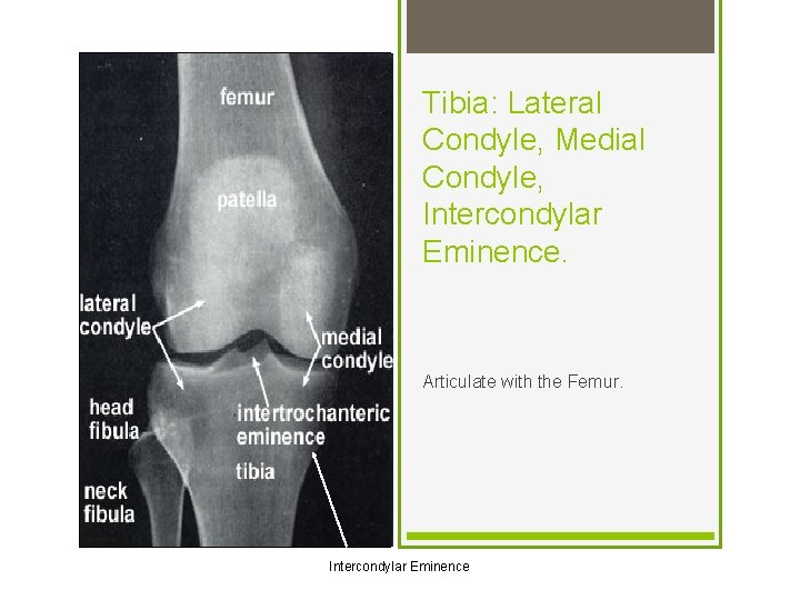 Tibia: Lateral Condyle, Medial Condyle, Intercondylar Eminence. Articulate with the Femur. Intercondylar Eminence 