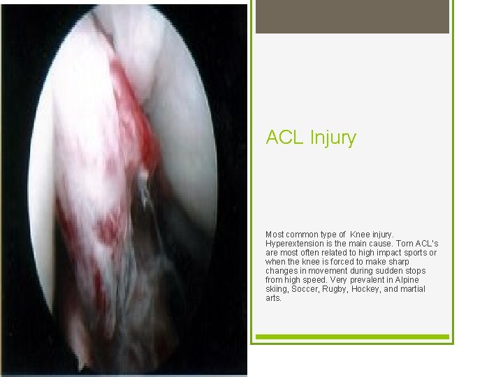 ACL Injury Most common type of Knee injury. Hyperextension is the main cause. Torn