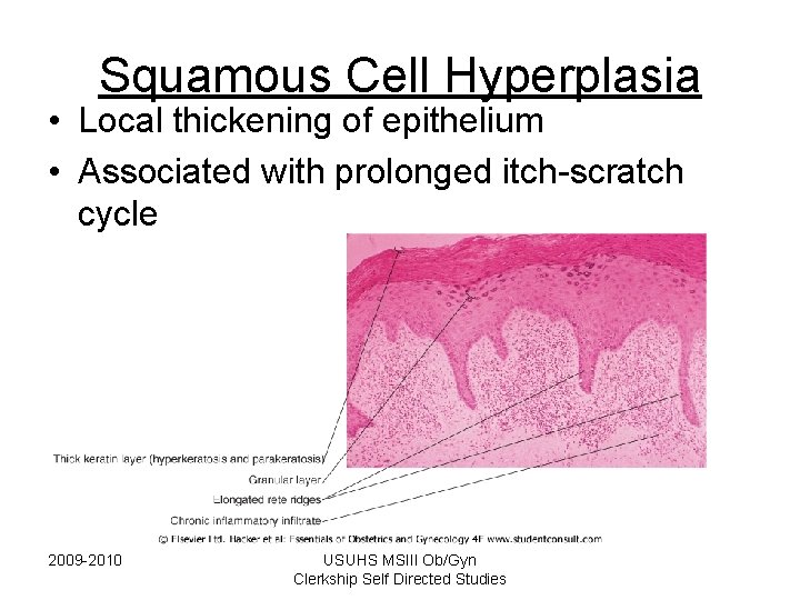 Squamous Cell Hyperplasia • Local thickening of epithelium • Associated with prolonged itch-scratch cycle Squamous Cell Hyperplasia • Local thickening of epithelium • Associated with prolonged itch-scratch cycle