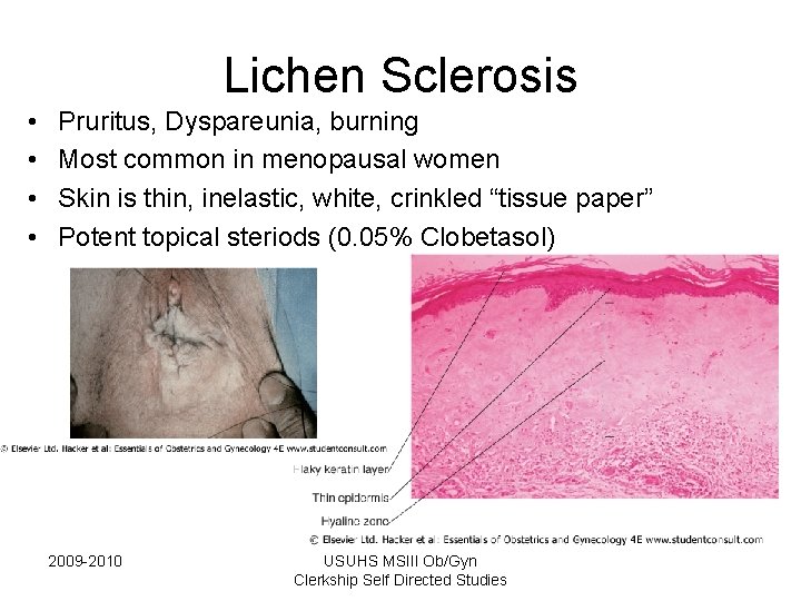 Lichen Sclerosis • • Pruritus, Dyspareunia, burning Most common in menopausal women Skin is Lichen Sclerosis • • Pruritus, Dyspareunia, burning Most common in menopausal women Skin is