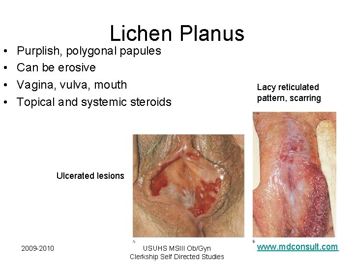 • • Lichen Planus Purplish, polygonal papules Can be erosive Vagina, vulva, mouth • • Lichen Planus Purplish, polygonal papules Can be erosive Vagina, vulva, mouth