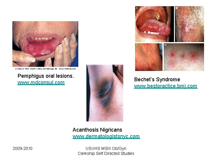 Pemphigus oral lesions. www. mdconsul. com Bechet’s Syndrome www. bestpractice. bmj. com Acanthosis Nigricans Pemphigus oral lesions. www. mdconsul. com Bechet’s Syndrome www. bestpractice. bmj. com Acanthosis Nigricans