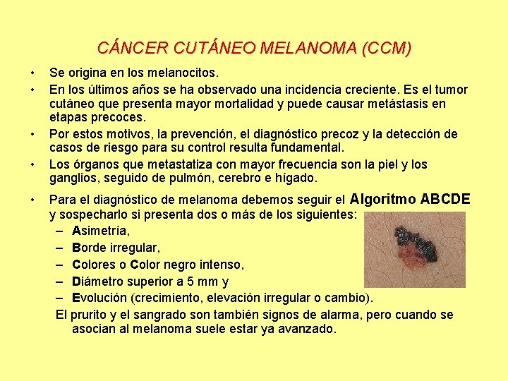 CÁNCER CUTÁNEO MELANOMA (CCM) • • • Se origina en los melanocitos. En los