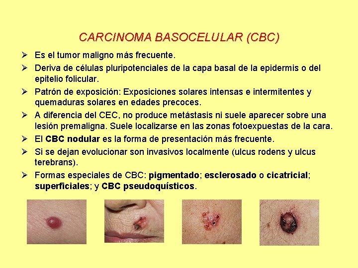  CARCINOMA BASOCELULAR (CBC) Ø Es el tumor maligno más frecuente. Ø Deriva de