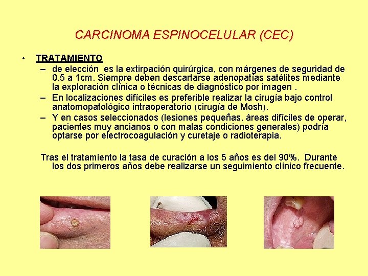 CARCINOMA ESPINOCELULAR (CEC) • TRATAMIENTO – de elección es la extirpación quirúrgica, con márgenes