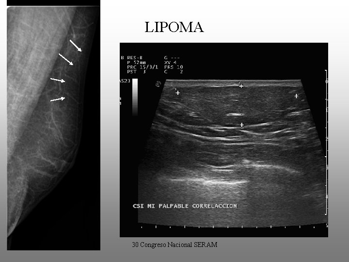 LIPOMA • Es la segunda lesión benigna más frecuente en la mama masculina. •