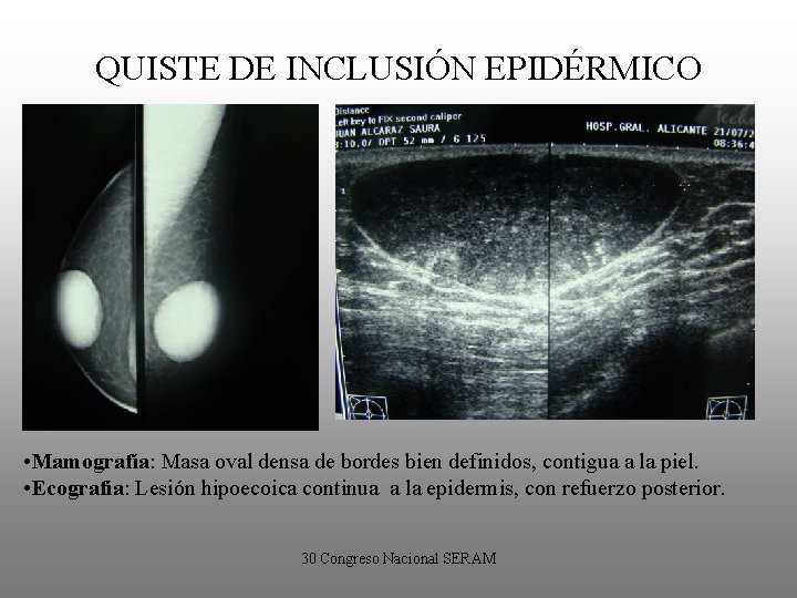 QUISTE DE INCLUSIÓN EPIDÉRMICO • Mamografía: Masa oval densa de bordes bien definidos, contigua