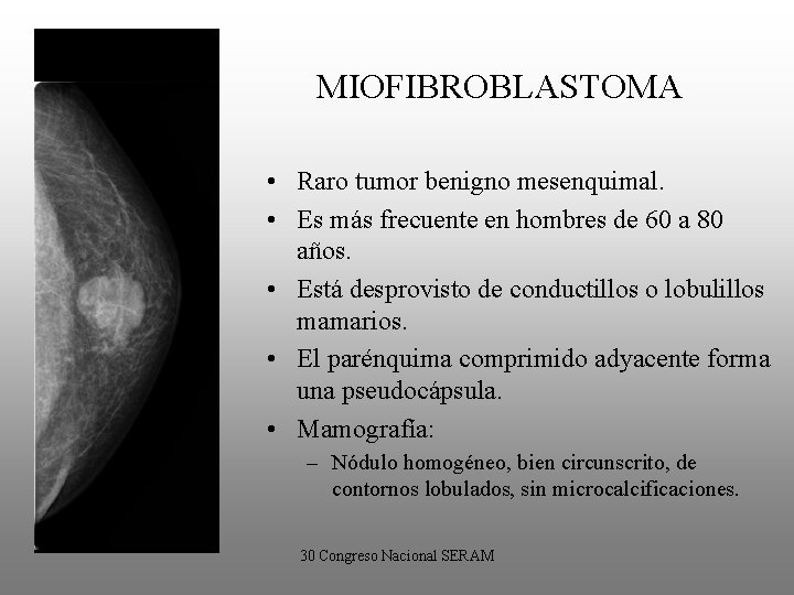 MIOFIBROBLASTOMA • Raro tumor benigno mesenquimal. • Es más frecuente en hombres de 60