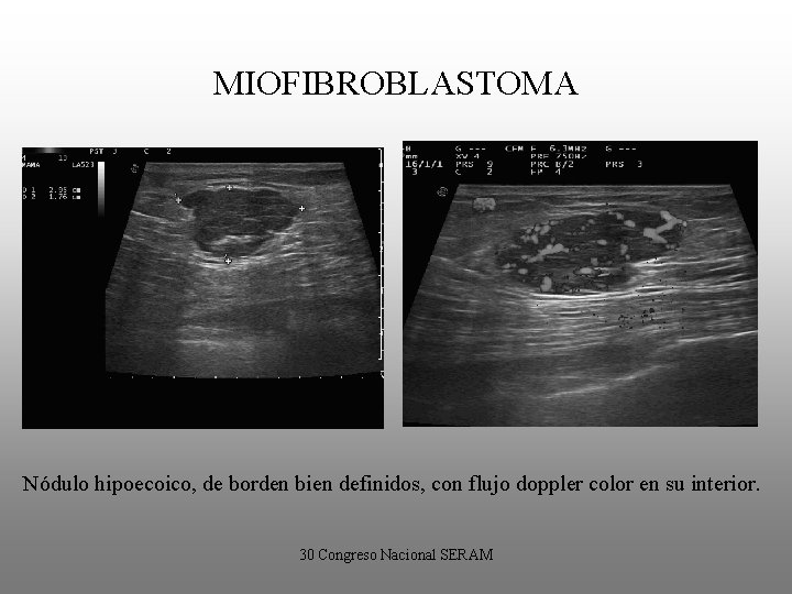MIOFIBROBLASTOMA Nódulo hipoecoico, de borden bien definidos, con flujo doppler color en su interior.