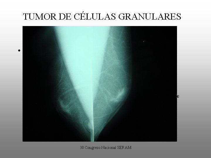 TUMOR DE CÉLULAS GRANULARES • Mamografía: – Nódulo de márgenes bien definidos o –