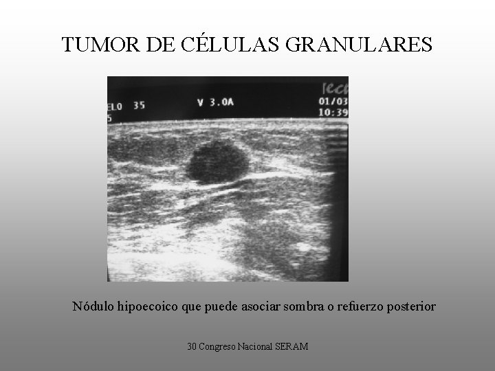 TUMOR DE CÉLULAS GRANULARES Nódulo hipoecoico que puede asociar sombra o refuerzo posterior 30