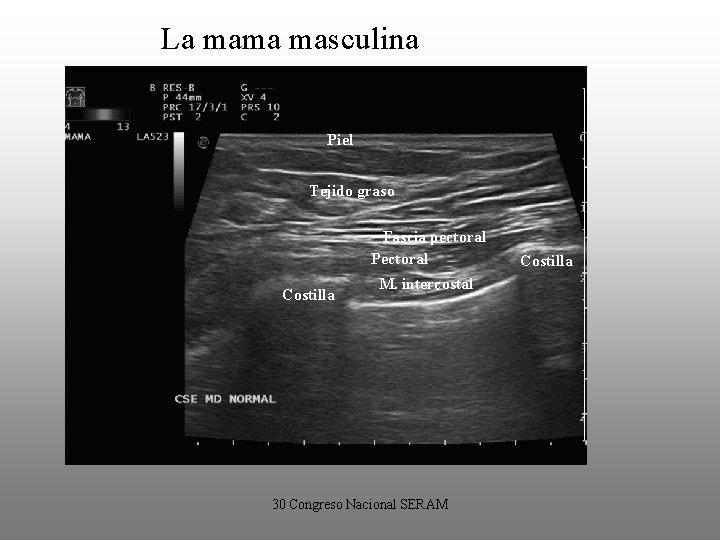 La mama masculina Piel Tejido graso Fascia pectoral Pectoral Costilla M. intercostal 30 Congreso