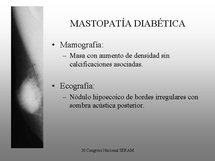 MASTOPATÍA DIABÉTICA • Mamografía: – Masa con aumento de densidad sin calcificaciones asociadas. •