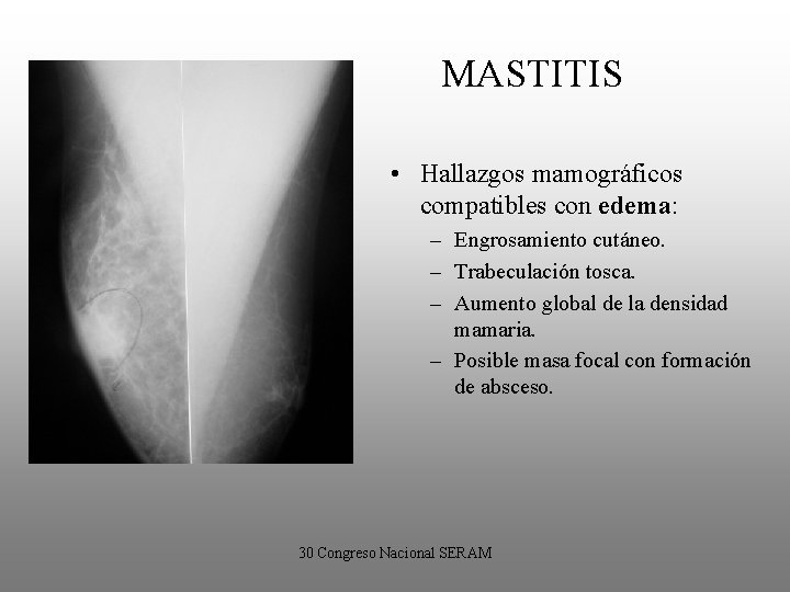 MASTITIS • Hallazgos mamográficos compatibles con edema: – Engrosamiento cutáneo. – Trabeculación tosca. –
