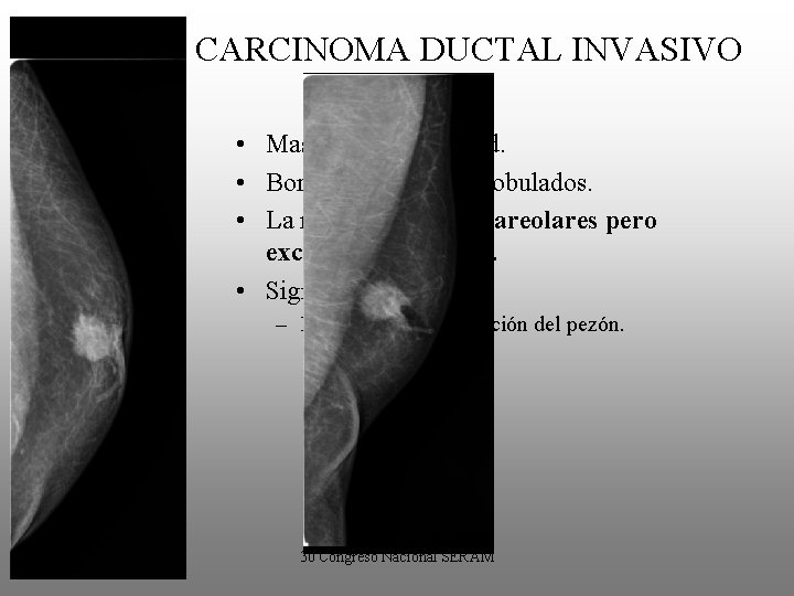 CARCINOMA DUCTAL INVASIVO • Masa de alta densidad. • Bordes espiculados, lobulados. • La