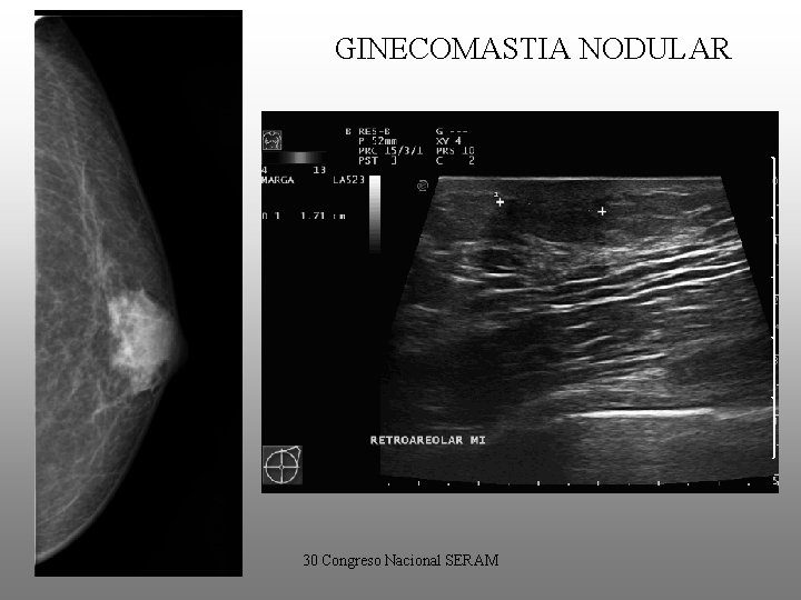 GINECOMASTIA NODULAR • “Fase florida”. • Ginecomastia < 1 año de evolución. • Mamografía:
