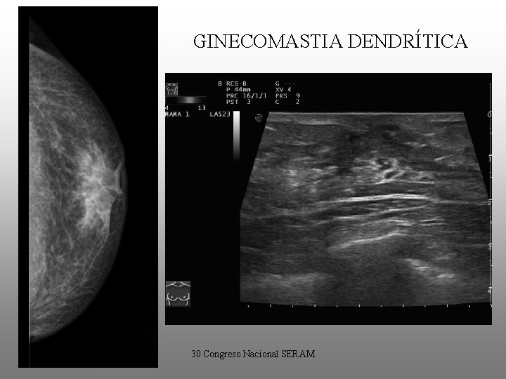 GINECOMASTIA DENDRÍTICA • • “Fase quiescente”. Ginecomastia > 1 año de evolución. Fibrosis irreversible.
