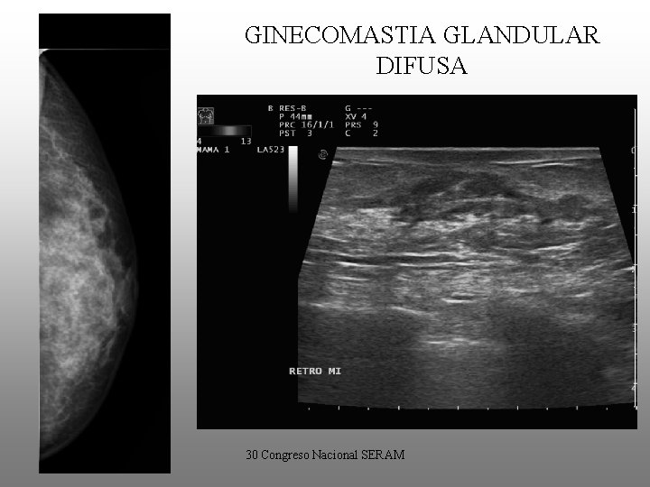 GINECOMASTIA GLANDULAR DIFUSA • Pacientes en tratamiento con estrógenos. • Mamografía: – Similar apariencia