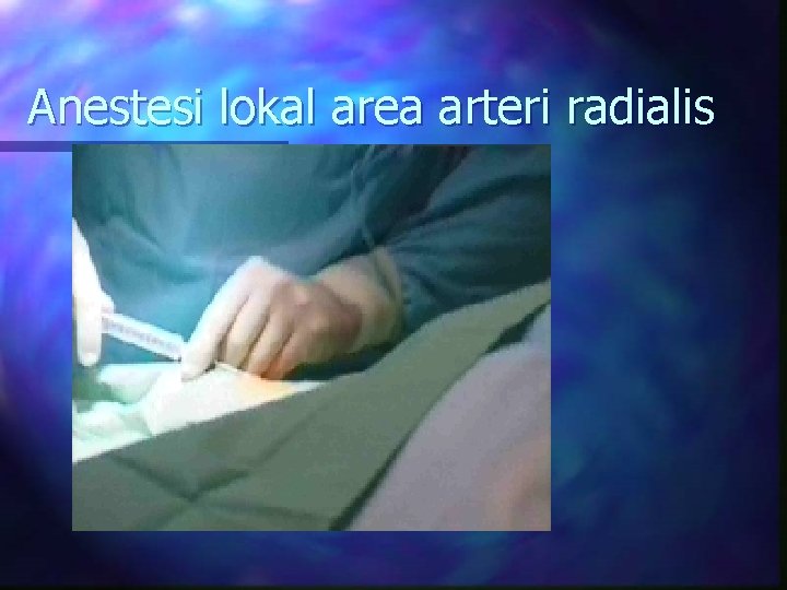 Anestesi lokal area arteri radialis 