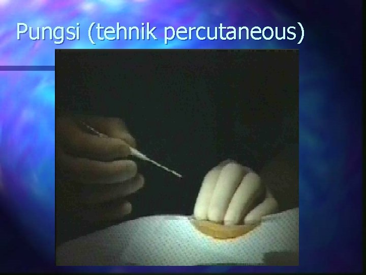 Pungsi (tehnik percutaneous) 