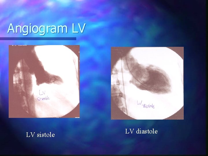 Angiogram LV LV sistole LV diastole 