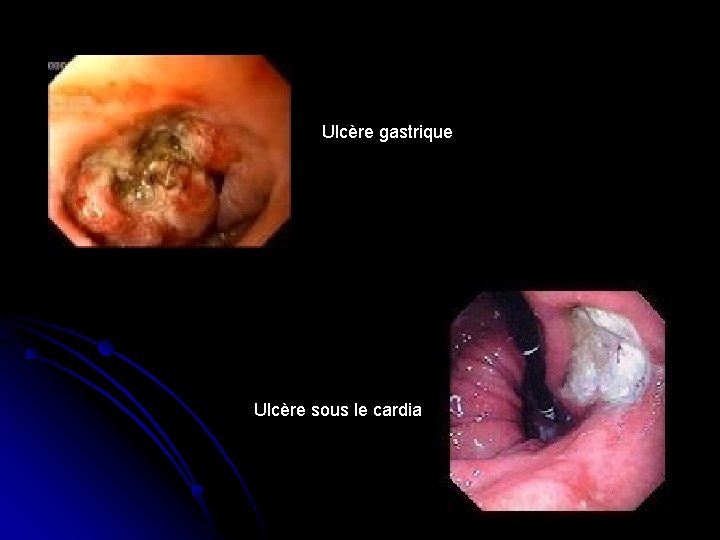 Ulcère gastrique Ulcère sous le cardia 