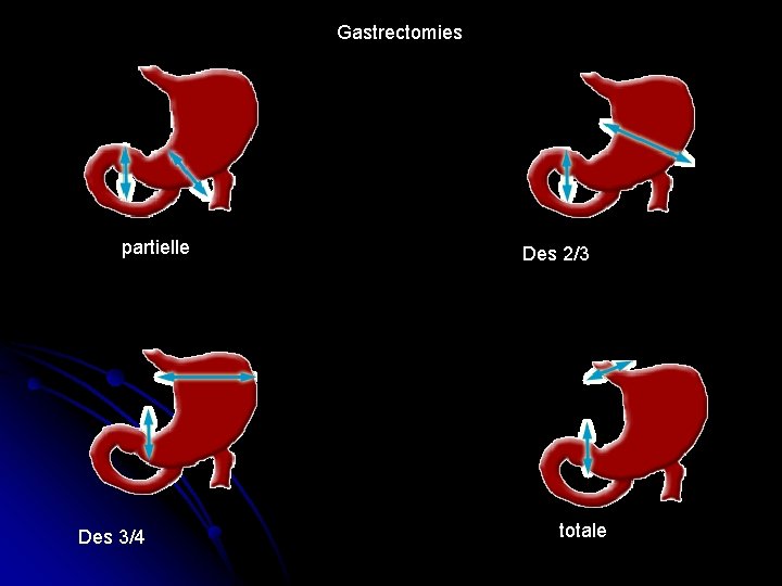 Gastrectomies partielle Des 3/4 Des 2/3 totale 