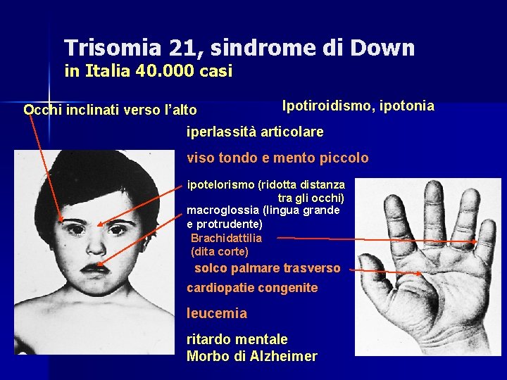 Trisomia 21, sindrome di Down in Italia 40. 000 casi Occhi inclinati verso l’alto