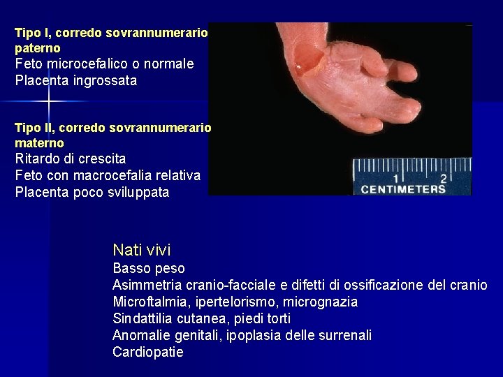 Tipo I, corredo sovrannumerario paterno Feto microcefalico o normale Placenta ingrossata Tipo II, corredo