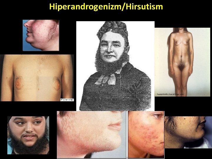 Hiperandrogenizm/Hirsutism Hiperandrogenizm/Hirsutism