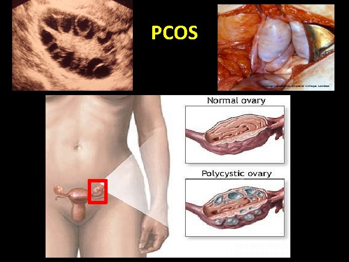 PCOS PCOS