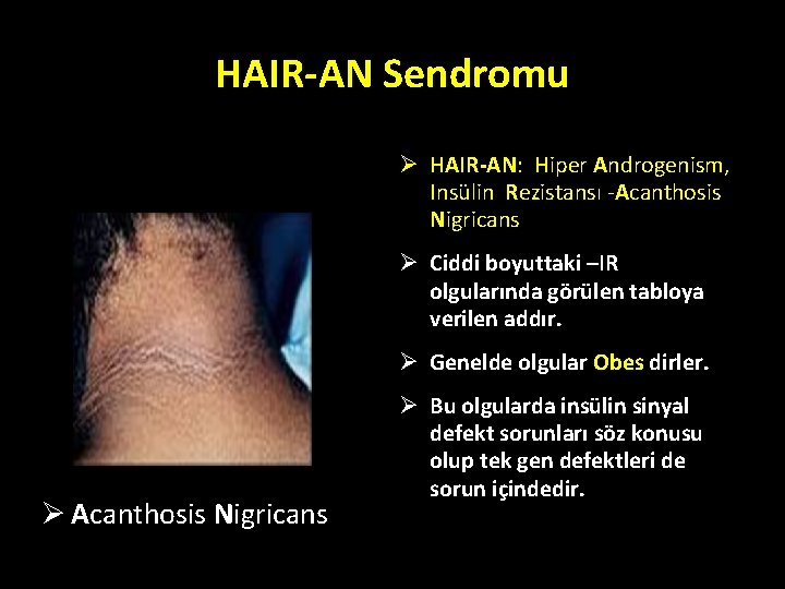 HAIR-AN Sendromu Ø HAIR-AN: Hiper Androgenism, Insülin Rezistansı -Acanthosis Nigricans Ø Ciddi boyuttaki –IR HAIR-AN Sendromu Ø HAIR-AN: Hiper Androgenism, Insülin Rezistansı -Acanthosis Nigricans Ø Ciddi boyuttaki –IR