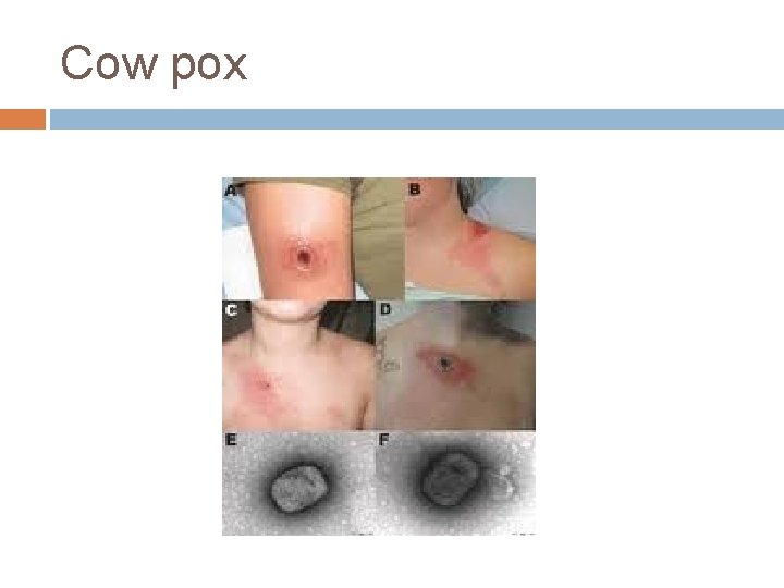 Cow pox Cow pox
