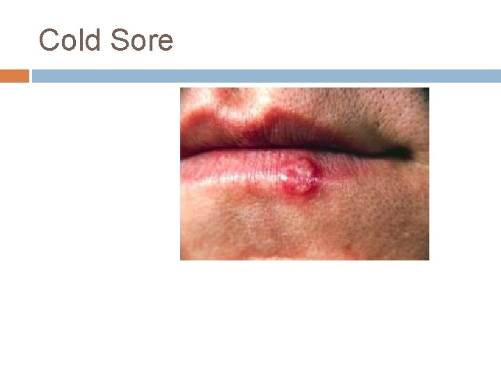 Cold Sore Cold Sore