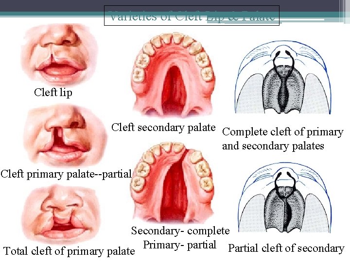 Varieties of Cleft Lip & Palate Cleft lip Cleft secondary palate Complete cleft of Varieties of Cleft Lip & Palate Cleft lip Cleft secondary palate Complete cleft of