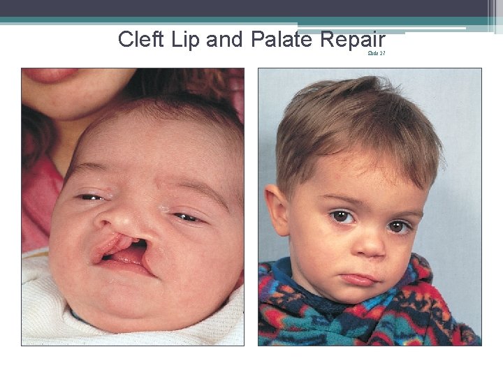 Cleft Lip and Palate Repair Slide 27 Cleft Lip and Palate Repair Slide 27