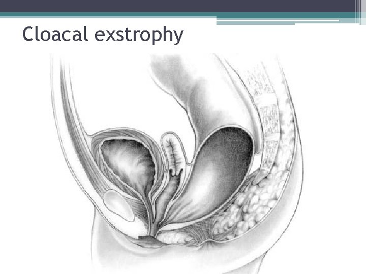 Cloacal exstrophy Cloacal exstrophy