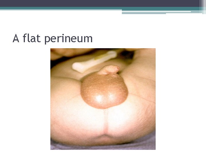 A flat perineum A flat perineum