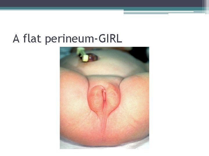 A flat perineum-GIRL A flat perineum-GIRL