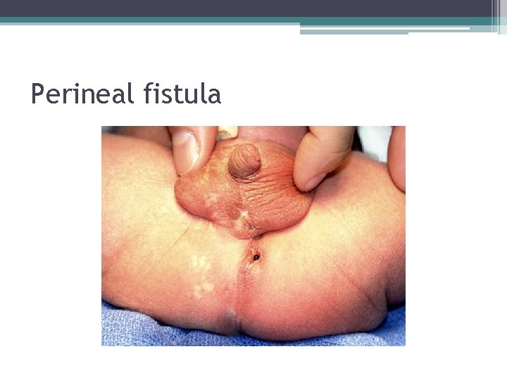 Perineal fistula Perineal fistula