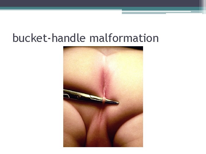 bucket-handle malformation bucket-handle malformation