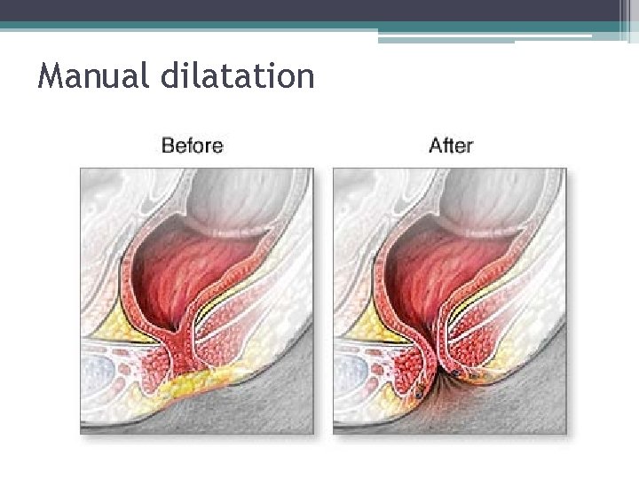 Manual dilatation Manual dilatation