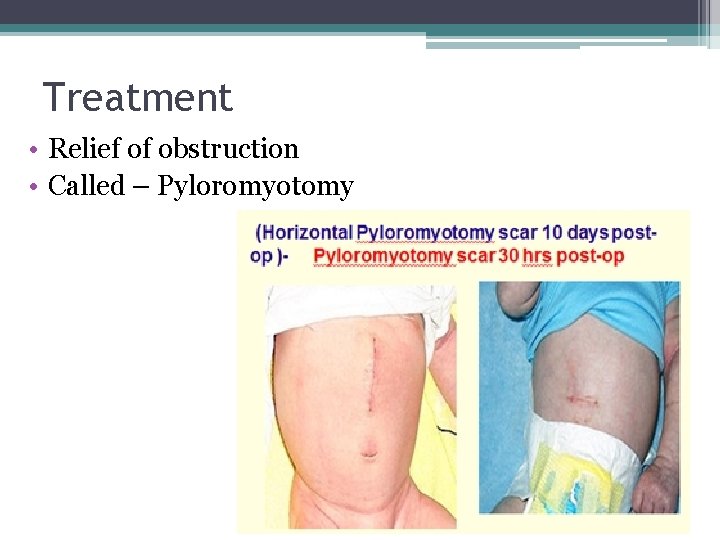 Treatment • Relief of obstruction • Called – Pyloromyotomy Treatment • Relief of obstruction • Called – Pyloromyotomy