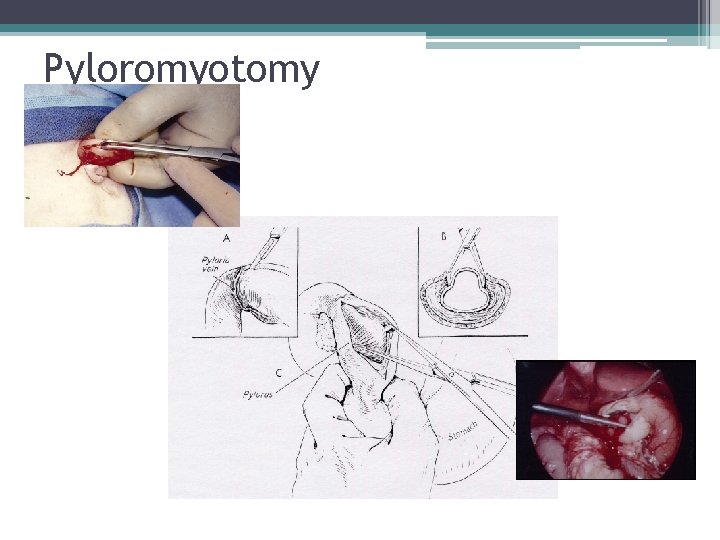 Pyloromyotomy Pyloromyotomy