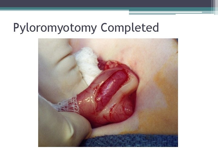 Pyloromyotomy Completed Pyloromyotomy Completed