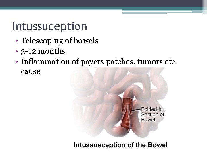 Intussuception • Telescoping of bowels • 3 -12 months • Inflammation of payers patches, Intussuception • Telescoping of bowels • 3 -12 months • Inflammation of payers patches,