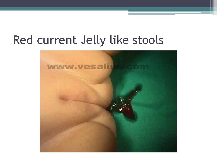 Red current Jelly like stools Red current Jelly like stools