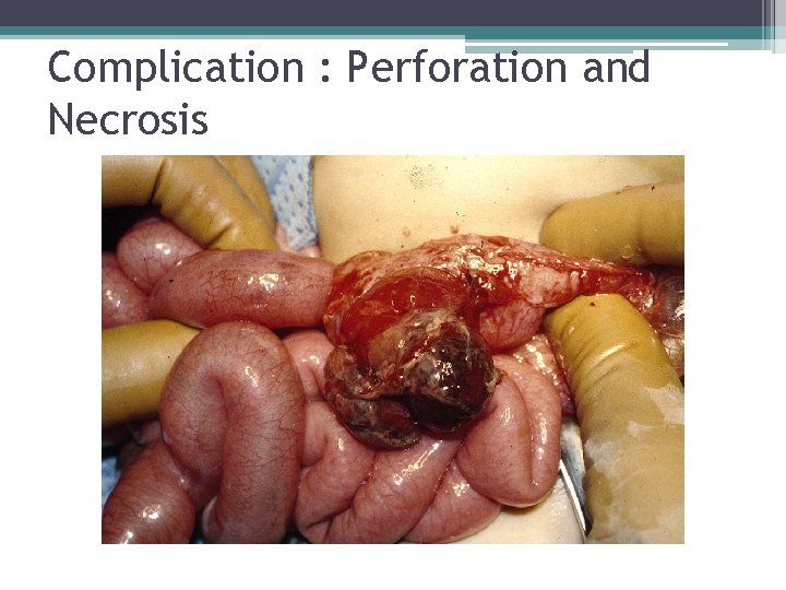 Complication : Perforation and Necrosis Complication : Perforation and Necrosis
