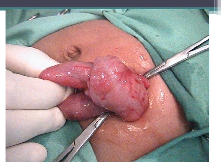 Intussusception Intussusception