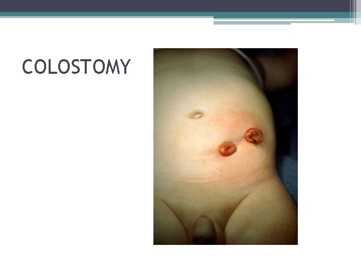COLOSTOMY COLOSTOMY
